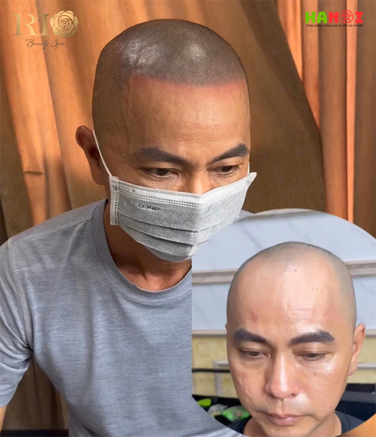 Xam-chan-toc-che-hoi-cai-thien-chan-toc-thua-cho-ca-nam-va-nu-2