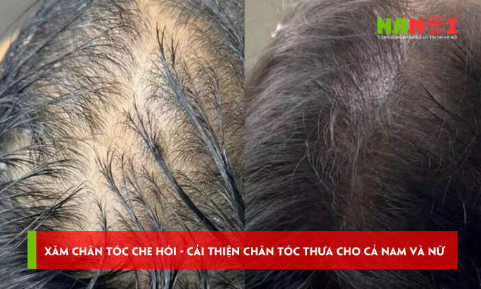 Xam-chan-toc-che-hoi-cai-thien-chan-toc-thua-cho-ca-nam-va-nu