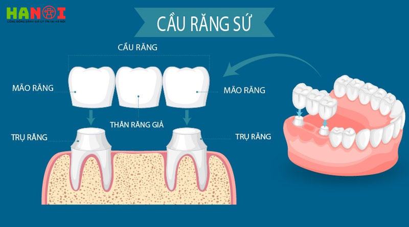 Lam-cau-rang-su-co-dat-khong-loi-khuyen-tu-chuyen-gia-nha-khoa-1-hanoitoplist