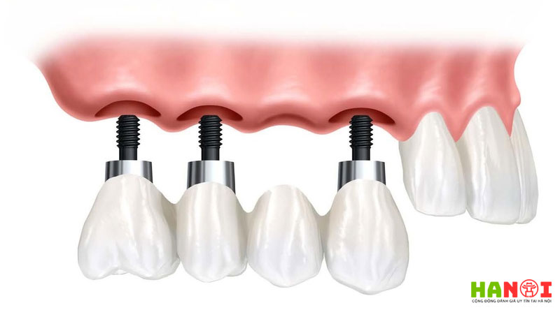 Lam-cau-rang-su-co-dat-khong-loi-khuyen-tu-chuyen-gia-nha-khoa-3-hanoitoplist