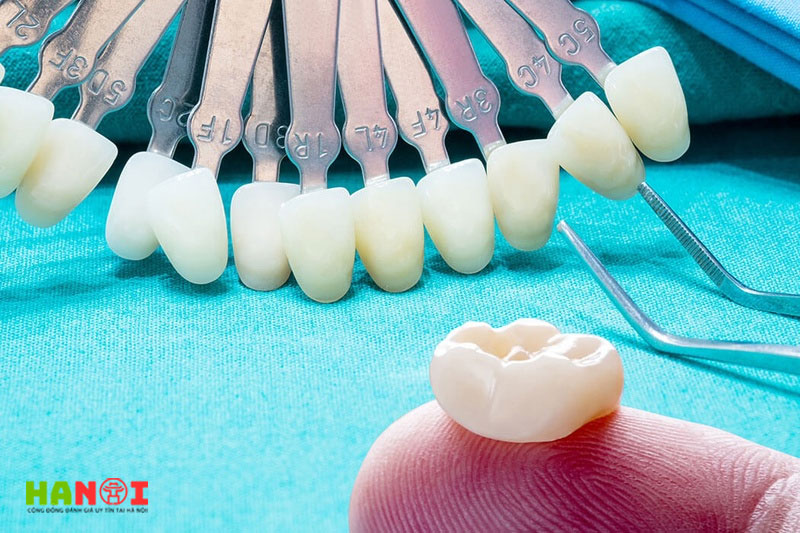 Lam-cau-rang-su-co-dat-khong-loi-khuyen-tu-chuyen-gia-nha-khoa-4-hanoitoplist