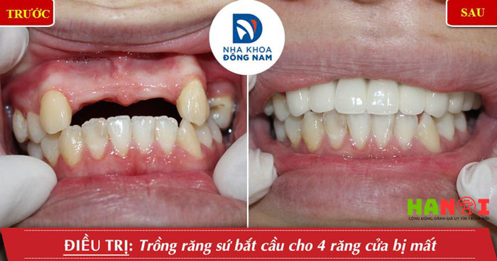 Lam-cau-rang-su-co-dat-khong-loi-khuyen-tu-chuyen-gia-nha-khoa-5-hanoitoplist