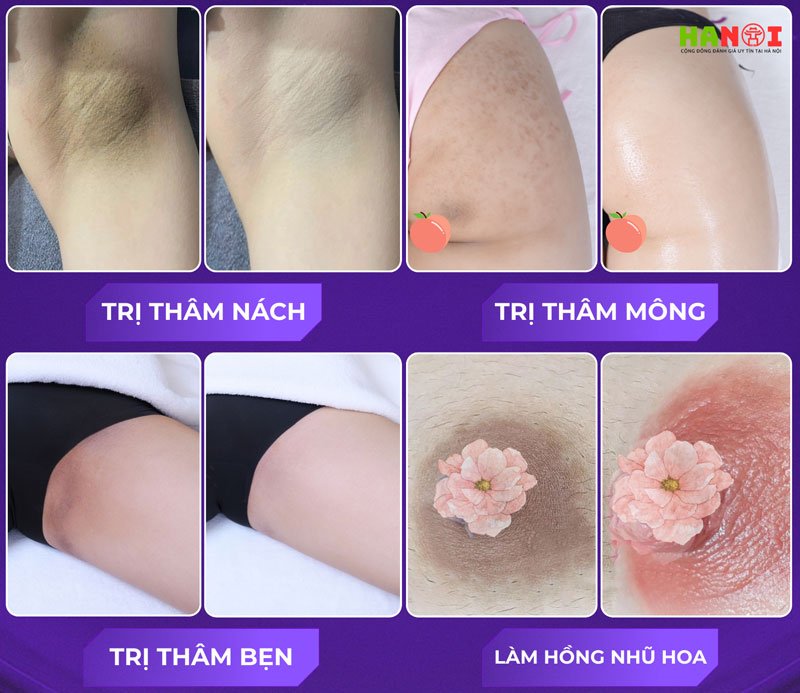 Review-lieu-trinh-tri-tham-body-tai-lg-clinic-vi-sao-duoc-nhieu-khach-hang-danh-gia-tot-1-hanoitoplist